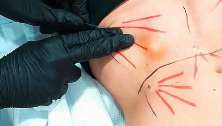 NUEVO: ENDOLYSE Abdominal – Resultados visibles sin cirugía¡Dile adiós a la grasa localizada y la flacidez abdominal de forma rápida, segura y efectiva!
