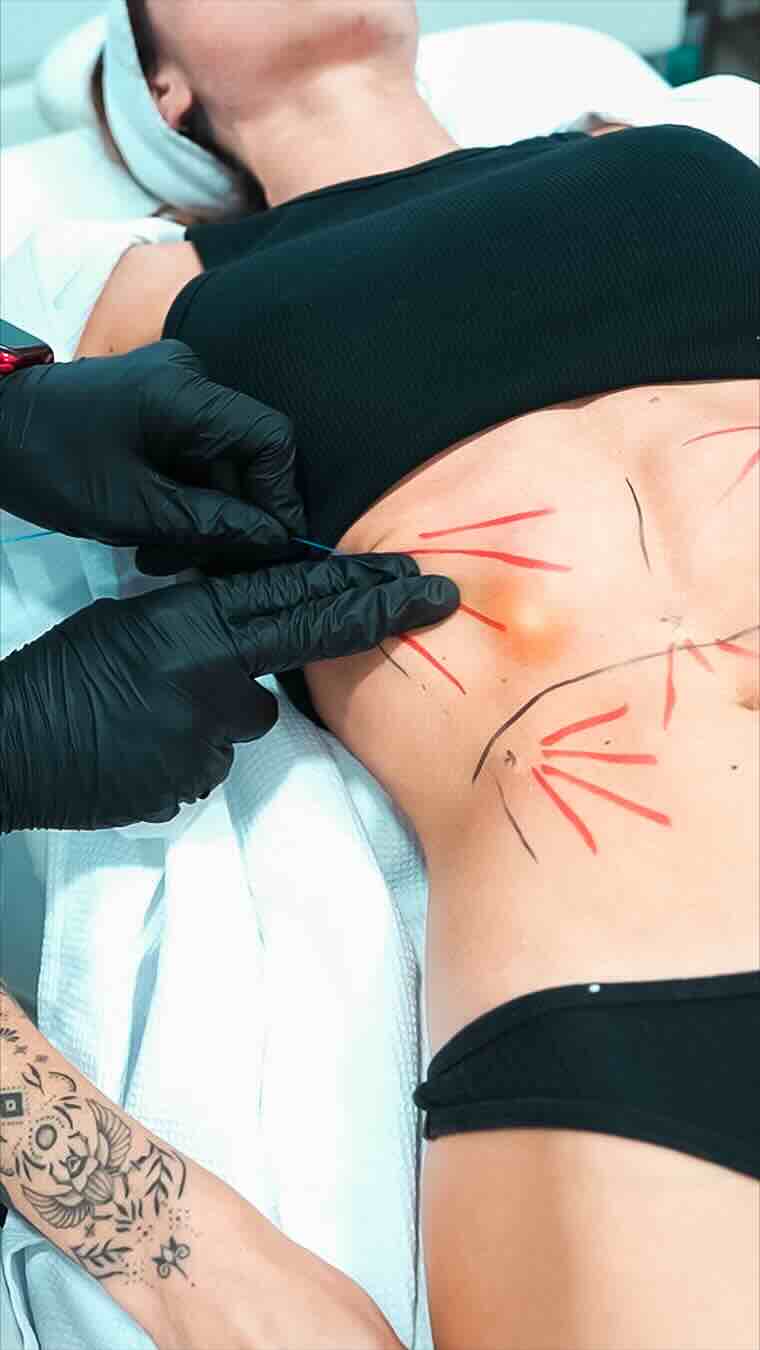NUEVO: ENDOLYSE Abdominal – Resultados visibles sin cirugía¡Dile adiós a la grasa localizada y la flacidez abdominal de forma rápida, segura y efectiva!